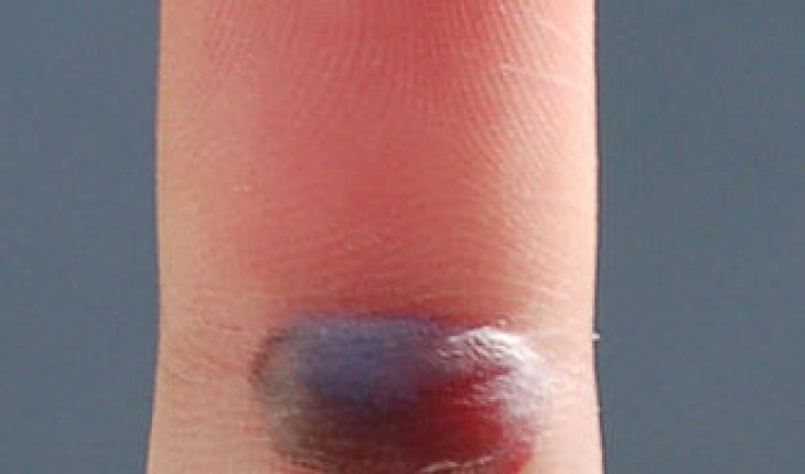 Should You Pop A Blood Blister The Should