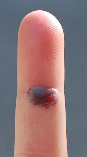 Should You Pop A Blood Blister The Should